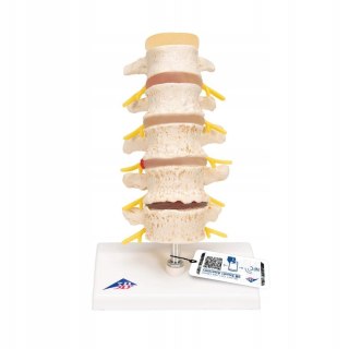 NAUKOWY MODEL ANATOMICZNY 3B SCIENTIFIC A795 ZWYRODNIENIE KREGÓW