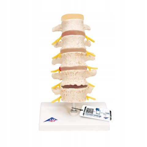NAUKOWY MODEL ANATOMICZNY 3B SCIENTIFIC A795 ZWYRODNIENIE KREGÓW