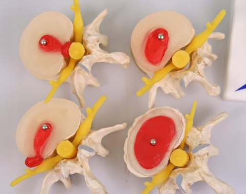NAUKOWY MODEL ANATOMICZNY 3B SCIENTIFIC A795 ZWYRODNIENIE KREGÓW