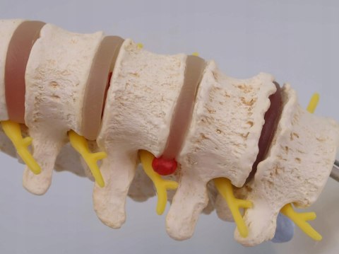 NAUKOWY MODEL ANATOMICZNY 3B SCIENTIFIC A795 ZWYRODNIENIE KREGÓW