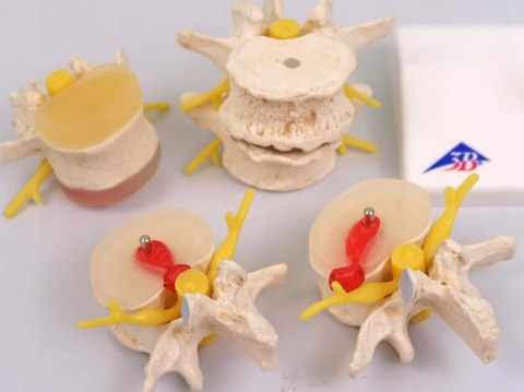 NAUKOWY MODEL ANATOMICZNY 3B SCIENTIFIC A795 ZWYRODNIENIE KREGÓW